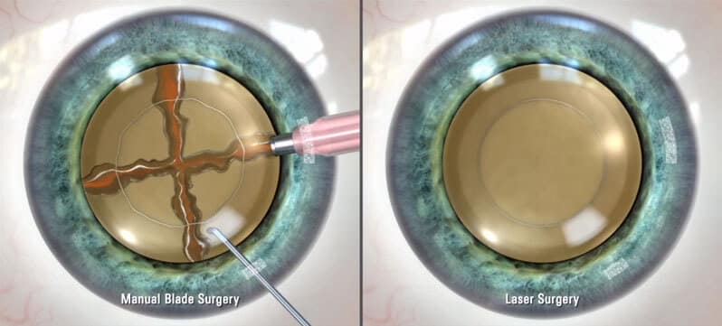 Chart Illustrating Cataract Surgery With a Manual Blade vs Cataract Surgery With a Laser